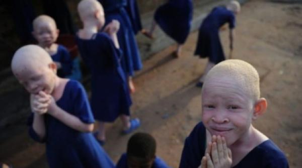 10 000 de albinosi se ascund pentru a nu fi ucisi