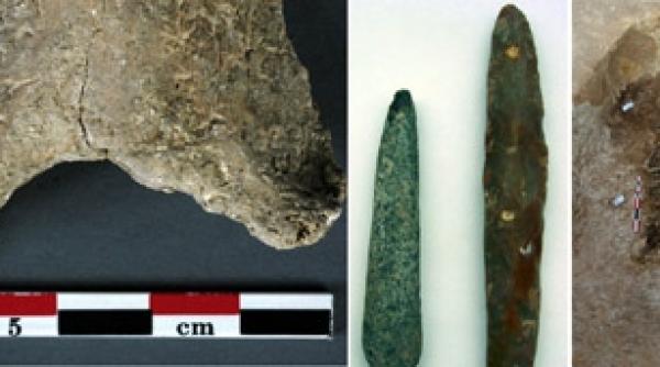 chirurgii din epoca de piatra