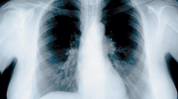 cancerul pulmonar nu se vede la radiografie