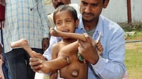 un baietel din india traieste cu membrele fratelui geaman in piept