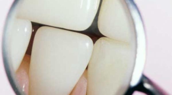 dinte pe dinte se vindeca