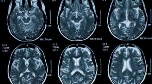 vaccin contra maladiei alzheimer