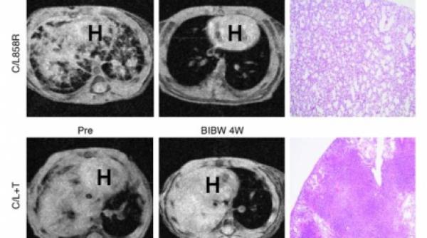 tratament nou pentru cancer