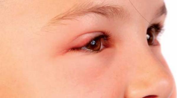 ochii mari la conjunctivite