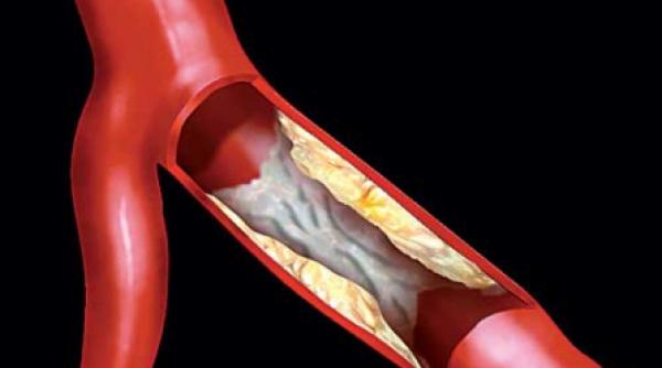 stenturile fac viitorul mai sigur
