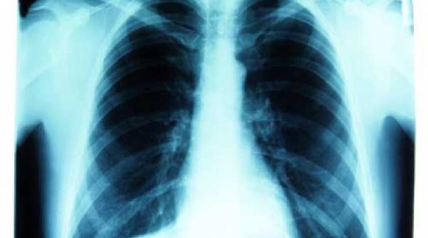 ce stim despre pneumonii