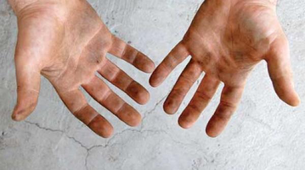 hepatita acuta se face pe picioare