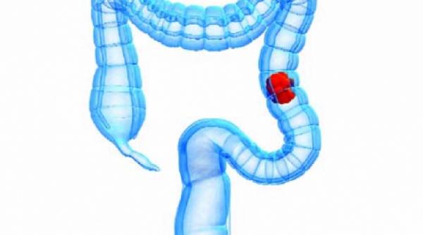 atentie la hemoragiile rectale