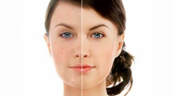 puncte negre si terapii verzi