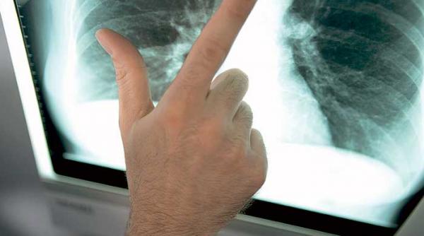 hipertensiunea arteriala pulmonara