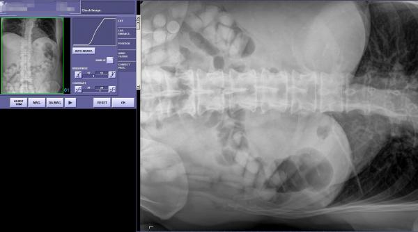 ascundea un kilogram de cocaina in stomac
