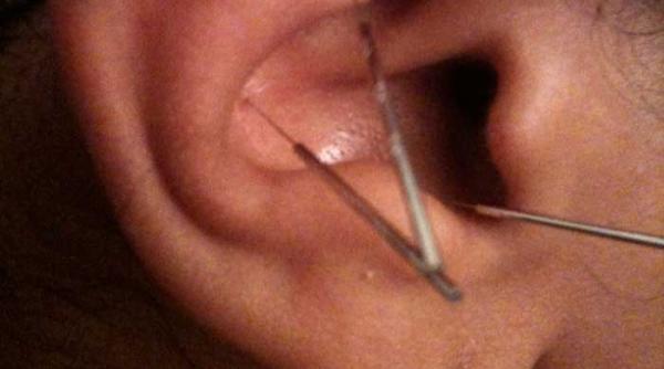 acupunctura in ureche te face mai suplu