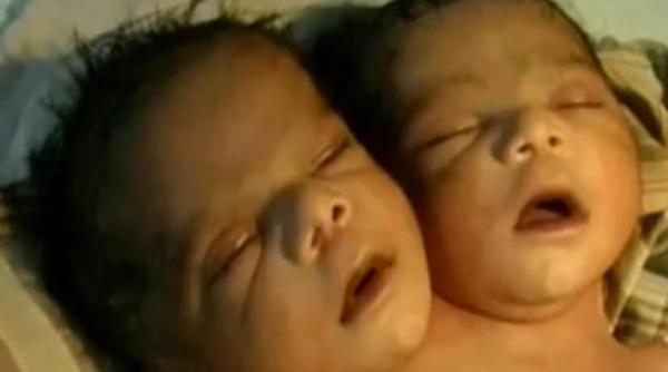 in india s a nascut un copil cu doua capete