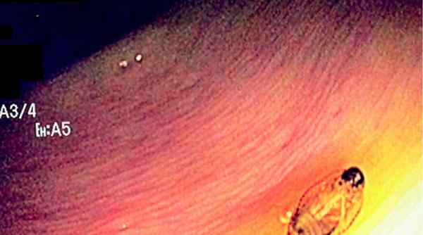 diagnosticata cu gandaci in fund