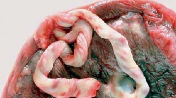 sanatate din sangele placentar