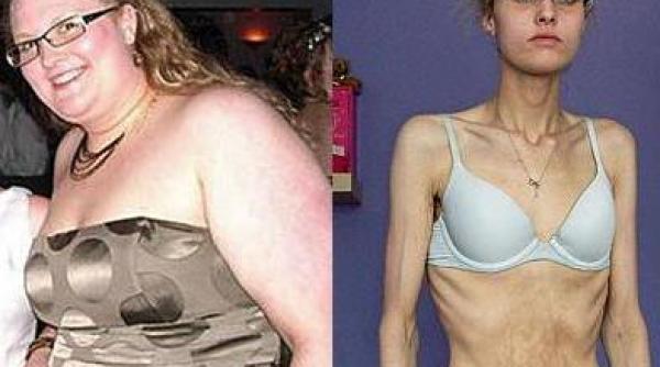 a ajuns piele si os din cauza anorexiei
