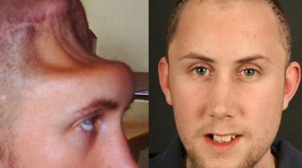 chirurgii au reconstruit 25 din craniul lipsa al unui tanar agresat in marea britanie