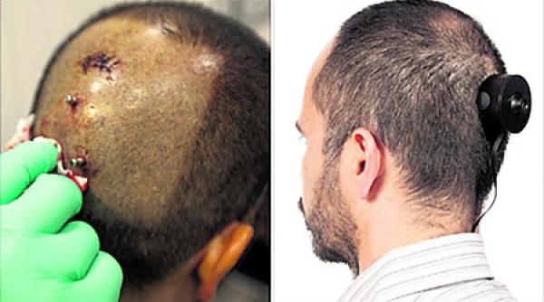 artistul care si a implantat o camera web in cap obligat s o scoata