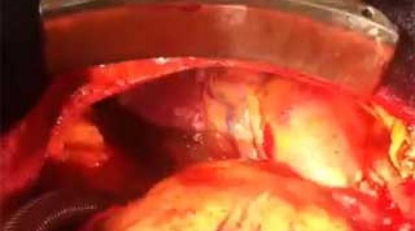 operatie medicala rara doua inimi bat in acelasi piept video