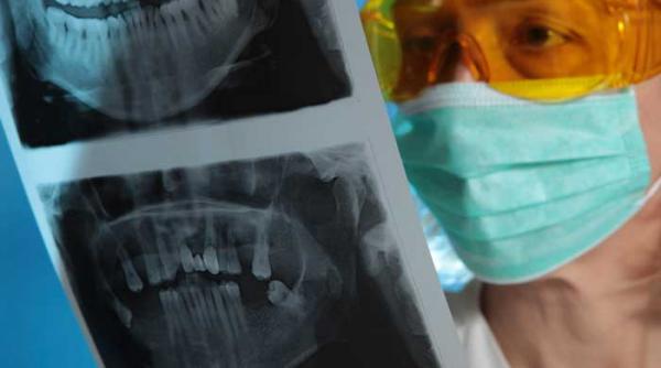 placute si suruburi de titan in mandibula