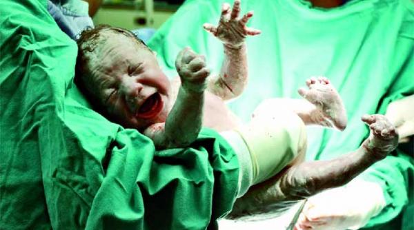 cezariana intre necesitate si trend