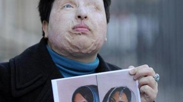 justitie in iran a castigat dreptul de a si orbi fostul iubit cu acid