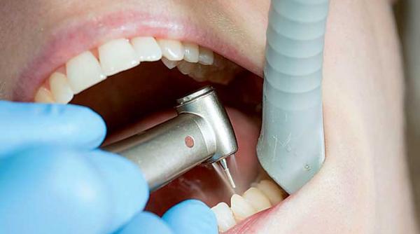 slefuirea cu prag a dintilor