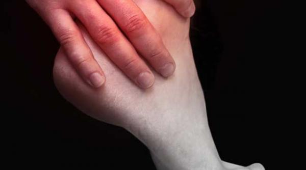 diabeticul trebuie sa si inspecteze picioarele