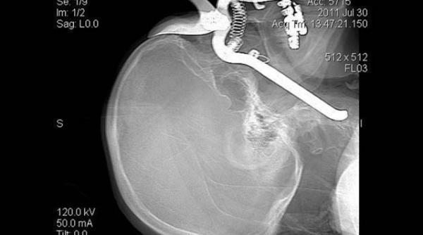 batran sanatos dupa ce manerul unei foarfece de gradinarit i a strapuns capul dinspre orbita pana in carotida