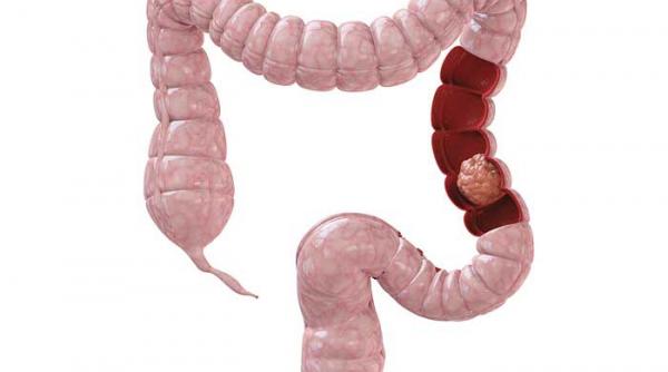 cum reducem riscul de cancer de colon