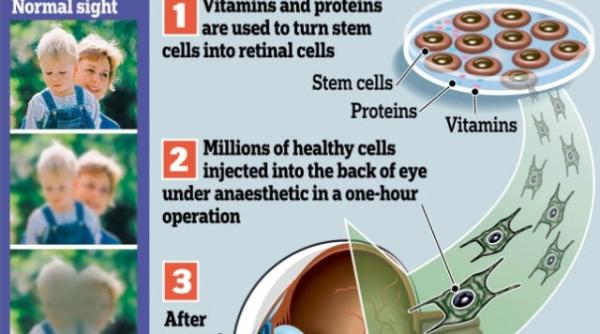 primul transplant oficial de celule stem din europa va avea loc la londra