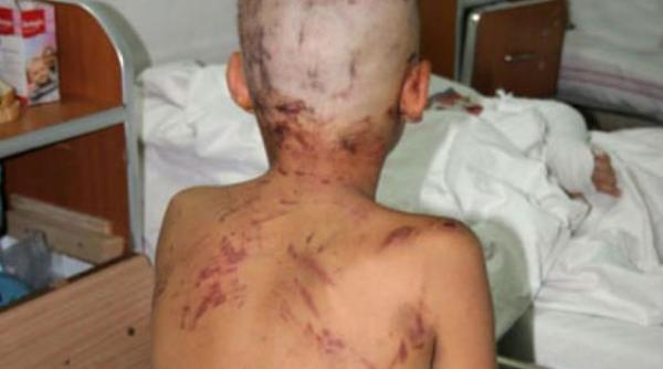 baiat de 12 ani mutilat de o haita de caini in vaslui