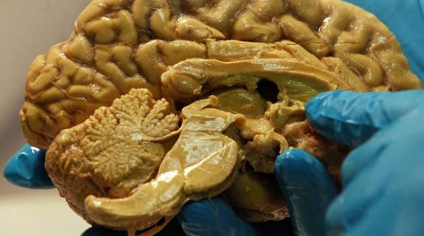 veste grozava pentru diabetici boala poate fi vindecata cu ajutorul celulelor stem ce se extrag de la pacient