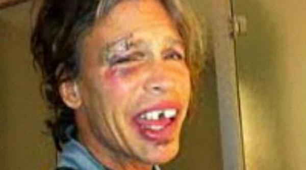 vezi cum arata steve tyler cu ochiul vanat si dintii sparti video