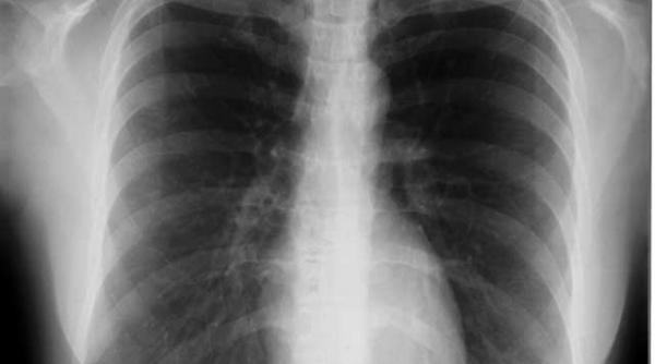 tabagismul sufoca plamanii tinerilor unul din 10 romani sufera de bpoc