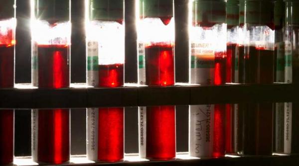 dignosticul cirozei printr un simplu test de sange