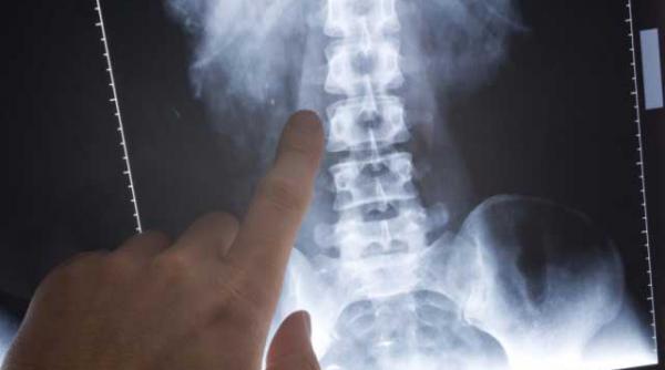 mersul sprinten si coloana vertebrala