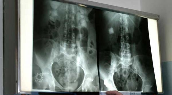 litotritia extracorporeala bombardarea cu unde soc a calculilor