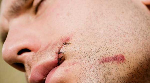 mare atentie la ulceratiile din gura