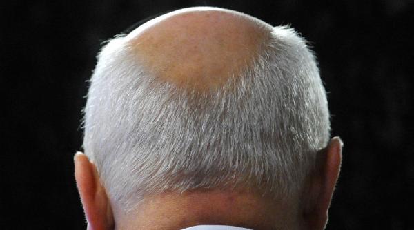 un tratament eficient impotriva calvitiei ar putea fi disponibil in viitorul apropiat