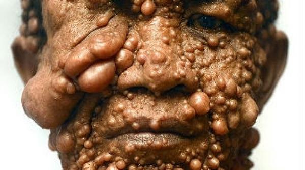 la 51 de ani ii este frica sa se uite in oglinda vezi cum arata un indonezian care sufera de o boala necunoscuta