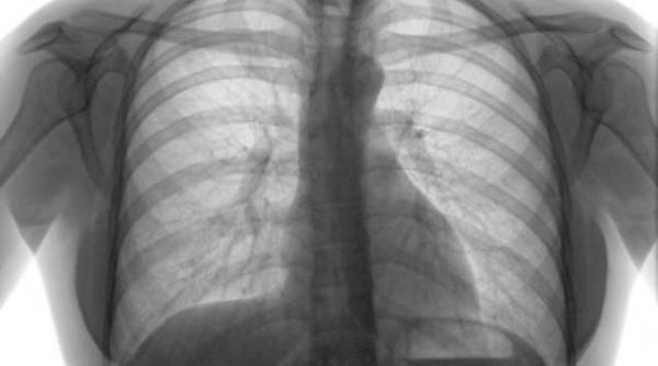 romania pe primul loc in ue la tuberculoza