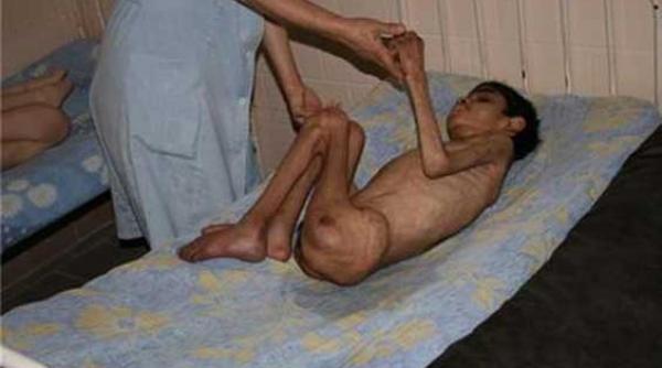 inuman orfelinatul unde copiii de 16 ani cantaresc 10 kilograme