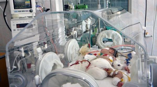 cea de a doua siameza internata la spitalul grigore alexandrescu din capitala a murit sora ei s a stins ieri dupa amiaza