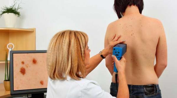campania de prevenire a melanomului