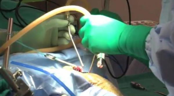 operatie pe creier transmisa live pe twitter 14 milioane de internauti au urmarit interventia chirurgilor video