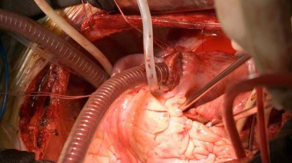 ce este angioplastia coronariana percutanata