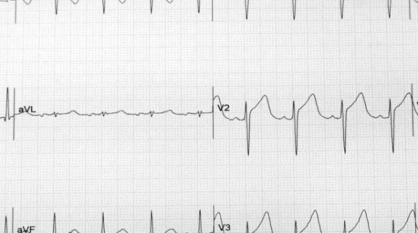 inima si stimulii electrici
