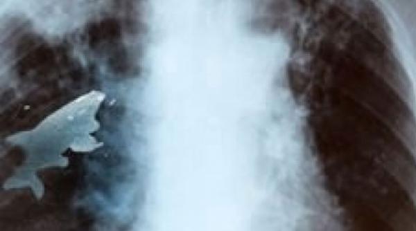 un peste s a intepenit in plamanul unui pusti de 12 ani ambii au supravietuit interventiei chirurgicale