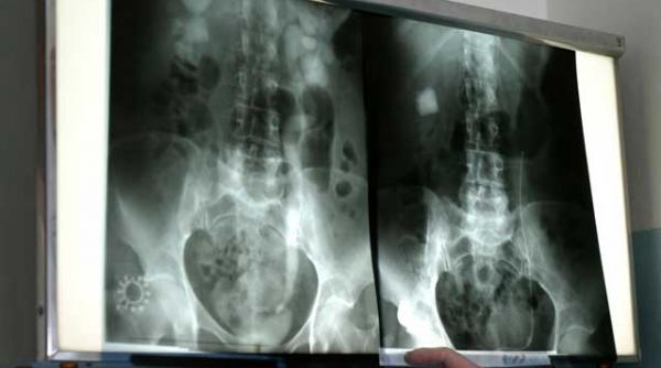 ce este urografia intravenoasa